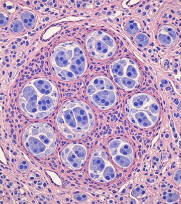 Comprehensive pathology guide to multinucleate cell angiohistiocytoma: clinical features, histopathology, and differential diagnosis.